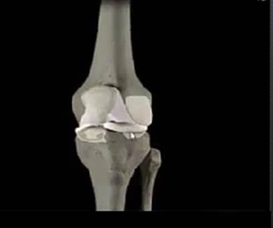 Prótesis Total Rodilla