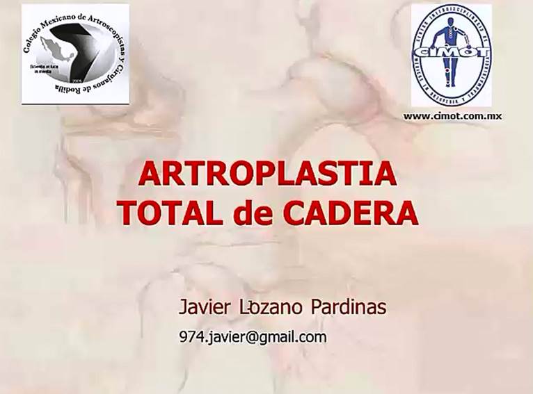 Artroplastía de Cadera
